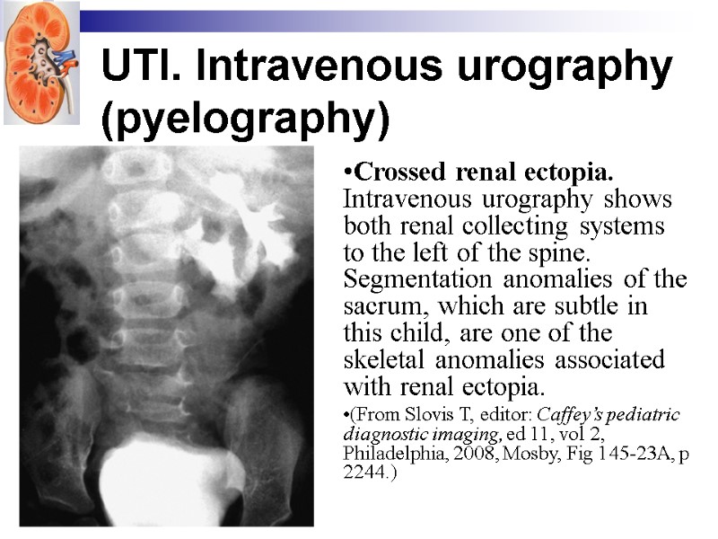 UTI. Intravenous urography (pyelography)  Crossed renal ectopia. Intravenous urography shows both renal collecting